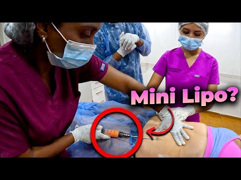 Is MINI LIPOSUCTION done by AREAS? Does it hurt? 🔥 MELA 2024 ✅