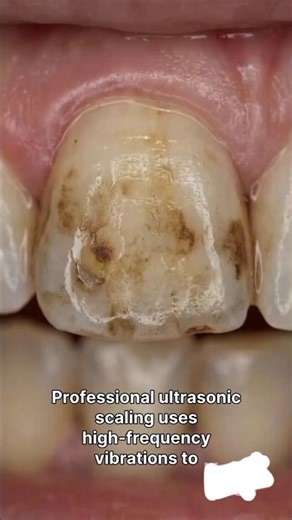 How Dentists Repair Teeth (AI Animation) 😱 | Tooth Fix Explained #dentaltreatment #dentalcare #short