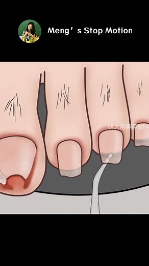 【超解壓腳趾護理動畫】🦶asmr toenail pedicure & toe hair waxing - Meng's Stop Motion #痘痘 #asmr #animations #定格動畫 #reels #治愈 #解壓視頻 | Meng's Stop Motion