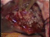 Petroclival Meningioma - Right-Retrosigmoid Approach • Video • MEDtube.net