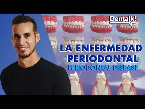 ¿Qué es la PERIODONTITIS? - TRATAMIENTO, síntomas y causas de la enfermedad periodontal | Dentalk! ©
