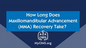 How Long Does Maxillomandibular Advancement MMA Recovery Take