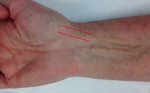 神经阻滞Nerve Blocks of the Wrist and Hand