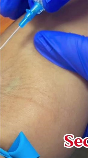 How to Obtain IV Access in Seconds!