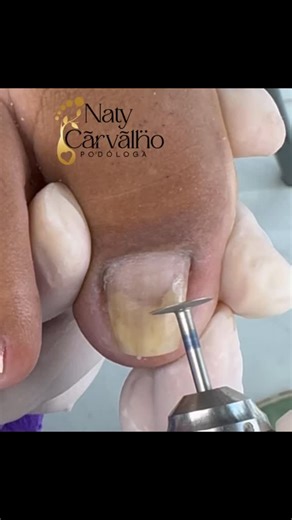Vídeos completos no meu canal do YouTube . . . #podologanatyscarvalho #podologa #podologia #nails #ingrowntoenail #ingrownhairremoval #satisfying #viral #viralvideos | natys_carvalho