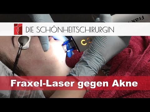 Akne Behandlung mit Fraxel Laser