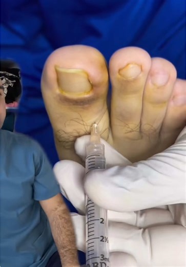 Proceso de MATRICECTOMIA QUÍMICA #uñasextremas