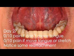 Laser Tongue Tie Revision Healing and Care Instructions