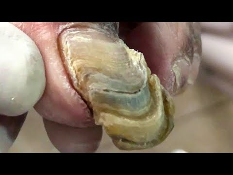Very Long Onychomycosis That Hasn’T Been Trimmed In More Than A Year【Pedicure Master Lin Jun】