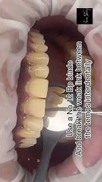 How to remove temporary veneers?