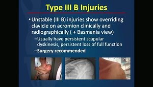 AC Separation: Why Do a Type III Acute Repair vs. Reconstrution
