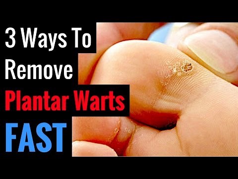 How To Get Rid Of Plantar Warts On Feet | 3 Natural Wart Remedies
