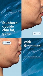 Say goodbye to that stubborn double chin fat and hello to long lasting results* when you’re treated with CoolSculpting®! ❄️ CoolSculpting® is an FDA Cleared nonsurgical fat reduction treatment that visibly eliminates fat in 9 areas of the body. *Data based on two case reports, results evident at 6 and 9 years post-treatment See more results at link in bio. Keep watching for Uses and Important Safety Information. Intended for US Audiences Only | CoolSculpting