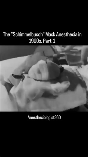 Abdul Malik on Instagram: "In the early 1900s, surgical anesthesia relied heavily on the Schimmelbusch mask, a wire-frame device placed over a patient’s face and covered with gauze. Using the "Open Drop Method," doctors would carefully drip liquid ether or chloroform onto the fabric, allowing the patient to inhale the evaporating vapors. While revolutionary for ending "the era of pain," the process was incredibly dangerous: ether was highly flammable, risking explosions in the operating room, an