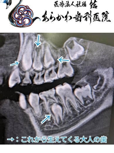 大人の歯、つまり、永久歯 はどこにいるのだろう?? 子供の歯しか生えてないけど、いつかはその子供の歯は無くなって、大人の歯にかわっていきます🦷 口の中から見えなくても、レントゲンを撮れば、大人の歯があるかないかわかります👏👏 今回は、ct という、3次元で撮れる画像があったので、それで見てみると、大人の歯が、生えてはないけど、顎の骨の中にいるのがよく分かります👀✨ よくよく歯医者さんで撮る パノラマエックス線写真 でもわかりますが、CTはその生えている位置や生えている方向、生えている向きも、ぜーんぶわかるので、より正確な位置がわかります。 大人の歯が出てくるのは、個人差はありますが、 5～7歳くらいになると、どこかしらから、ひょこっと大人の歯が出てくる年齢になります。 そのくらいの年齢になったら、1度歯医者さんでレントゲンを撮ってもらうと、大人の歯がアゴに隠れているのが良く見えるので、1度は撮ってもらい、診てもらうと良いと思います！ #あらかわ歯科医院 #歯医者 #医療法人社団結 #小児歯科 #生え変わり