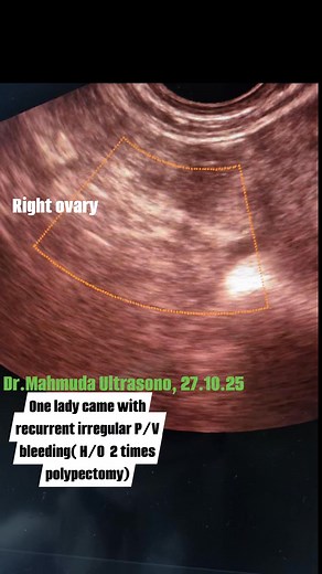 #endometrialpolyp #endometrialpathology #endometrialhyperplasia #tvsscan #reelsviral #polypectomy #infertility | Dr Mahmuda Ultrasono