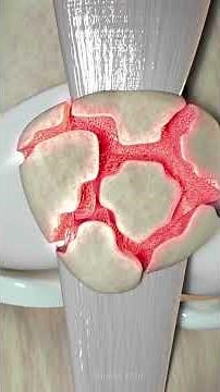 Comminuted Displaced Patella Fracture