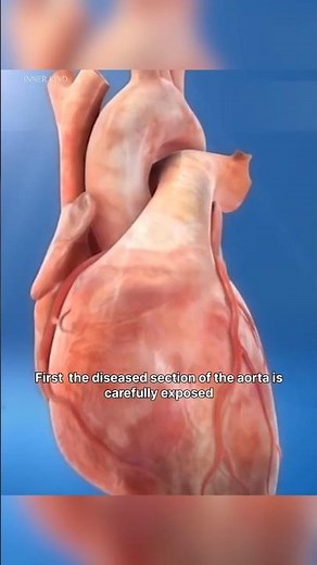 Life Saving Ascending Aorta Surgery Explained in 3D