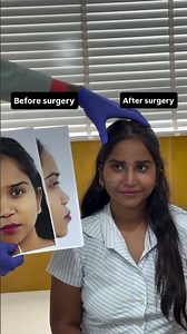 Splint removal day- Rhinoplasty surgery journey