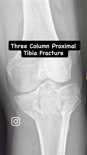 Just Ortho Things | One year follow up of a comminuted three column proximal tibia fracture! . . . . .. . . #trauma #ortho #fracture #bone #surgery... | Instagram