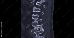 CT myelography or myelogram from computed tomography (CT-scanner) to look for problems in the spinal canal. Stock Video