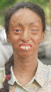 I'm happy despite my scaly skin | Born Different