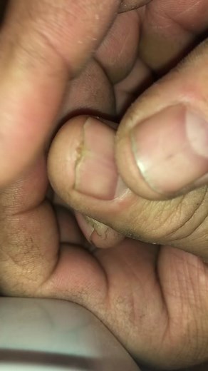 My infected thumb #pimple #pimplepopping #infection