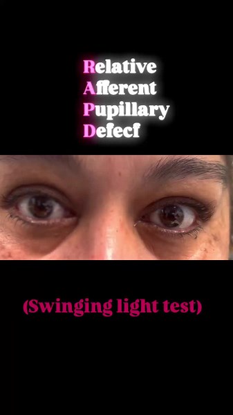 Relative Afferent Pupillary Defect Explained