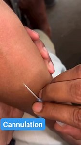 73K views · 443 reactions | Iv cannulation in emerging dept. #doctor #icunurse #ICU #nursing #nurse #emergency #laboratory | Md Refatullah | Facebook