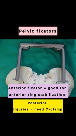 Active Life Orthopaedics on Instagram: "🔒 C-Clamp = best friend in posterior pelvic fractures! Rapid stabilization & bleeding control when every second counts. 🩸🚑 . . . . . . . . . . . #CCLAMP #PelvicFracture #PosteriorPelvicInjury #TraumaSurgery #Orthopedics #EmergencyMedicine #LifeSavingProcedure #SurgicalPearls #MedEd #OrthoSurgery #TraumaCare #CriticalCare #SurgicalSkills #EmergencyTrauma #ortholife #medicalreels #residencylife"