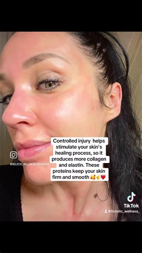 COLLAGEN induction THERAPY !