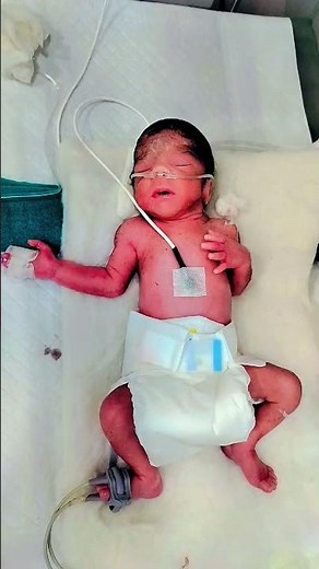 New Admission New born male baby Required o2 Mild RDS pretram LBW