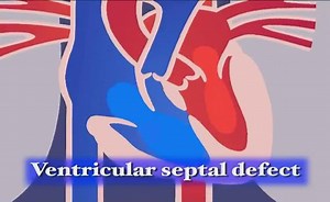 Ventricular Septal Defect