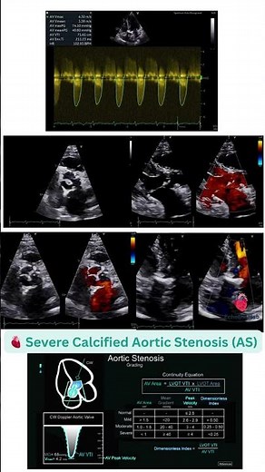 🫀 Severe Calcified Aortic Stenosis (AS) #SevereAS #CalcifiedAorticValve #AorticStenosis #2DEcho