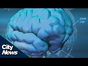 What is COVID-19 “brain fog” and why should we be concerned?