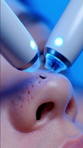 Vacuum & Ultrasonic Blackhead Extraction | Oddly Satisfying
