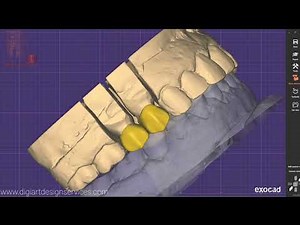 Step by Step tutorial how to design crown & bridge using Exocad