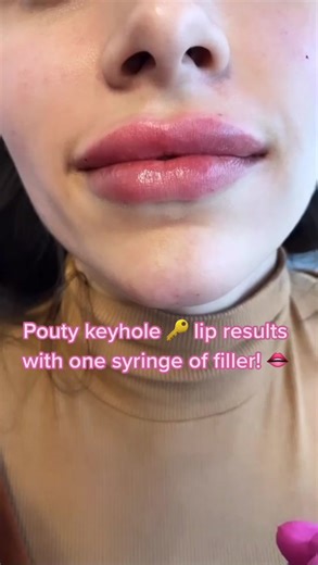 Keyhole Lip Filler Results: Stunning Transformation!