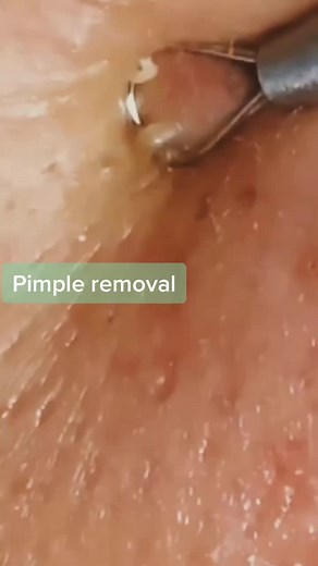 #greenscreenvideo #yoyomcn #pimplepopping #pimpleremover #extractions #zitpopper #acnevideos oddly satisfying