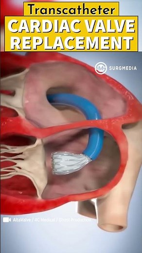 Cardiac Valve Replacement #medical #tech #science #doctor #heart