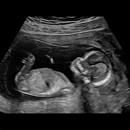 14weeks 2days Gender & Wellbeing Scan👶🏼 Ready to discover if it’s team PINK or team BLUE ??🩷💙 Our Gender Scans are available to book from 14 weeks!! Includes 2 printed images of your choice 🫧✨ BOOK ONLINE: https://3d4dbabyultrasoundscan.co.uk CONTACT US: 📞-01244 816922 📧-info@babyscanningboutique.co.uk 📍-63 Chester Road West, Shotton, CH5 1BZ #babyscan #babyscanningboutique #babylove #genderscan #4d #3dscan #bondingmoment