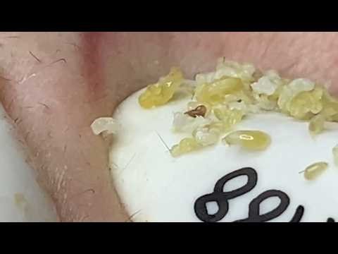 Relax & Unwind: Gentle Acne Treatment (ASMR) # 11| Loan Spa