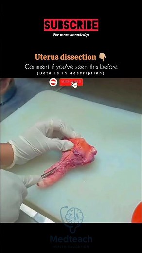 Uterus Dissection Explained in 30 Seconds | Anatomy Breakdown | #youtubeshorts