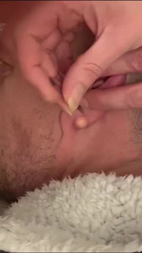 #duet with @DailyDoseOfPimplePopping Wait til the end for a satisfying pop 💥 #drpimplepopper #popaholic #dppreacts #pimplepopperaddict