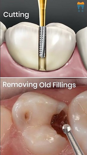 Carbide vs. Diamond Burs ⚡ Which One is Best for You? Find Out Now! 🦷 #shorts