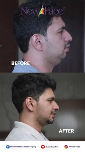 MIT Jaw Surgery Explained | Minimally Invasive, Scarless & Faster Recovery