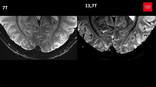 ⭐Première mondiale : le cerveau dévoilé comme jamais grâce à l’IRM le plus puissant au monde conçu et développé au CEA 🧠 Le CEA dévoile pour la première fois au monde, une série d’images de cerveau obtenue avec le scanner IRM Iseult, doté d’un champ magnétique inégalé de 11,7 teslas. Ce succès marque la concrétisation de plus de 20 années de R&D autour du projet Iseult dont l’objectif était de construire le scanner IRM le plus puissant au monde pour pouvoir imager à un niveau de résolution jama