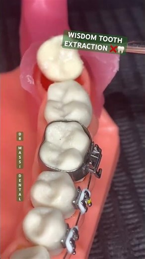 WISDOM TOOTH EXTRACTION ❌🦷