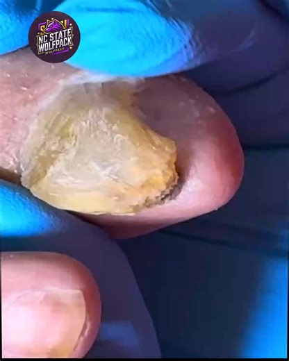 3.5K views · 35 reactions | Simple Steps to Support Overgrown Toenails Recommended by Experts #ThickToenailCare #NailFixTips #SafeNailCare #ToenailSupport | NC State Wolfpack on TheWolfpacker.com | Facebook