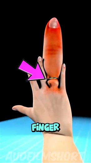 If You Ever Get A Ring Stuck On Your FINGER! 💍👆🏻